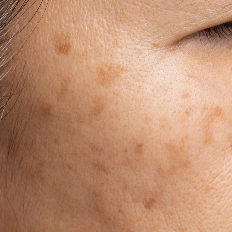 Pigmentation